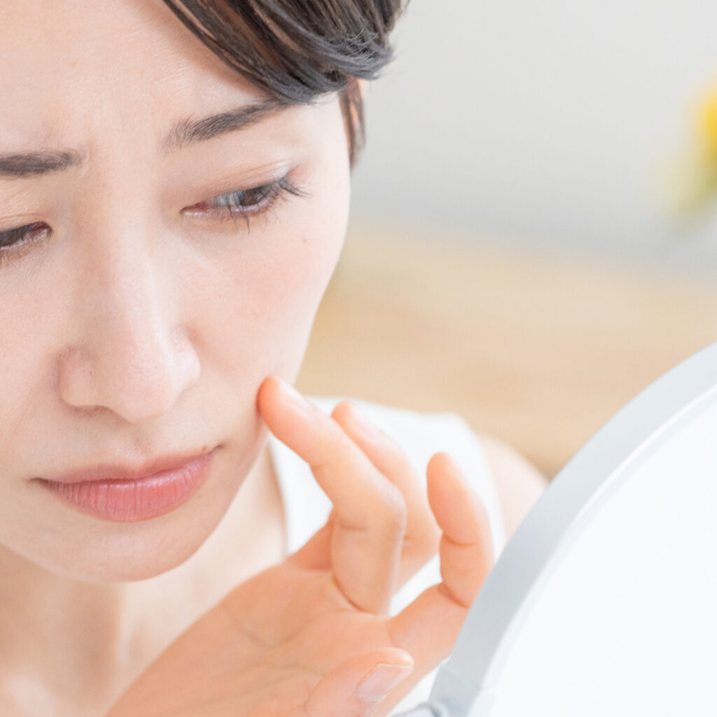 ニキビの改善と予防