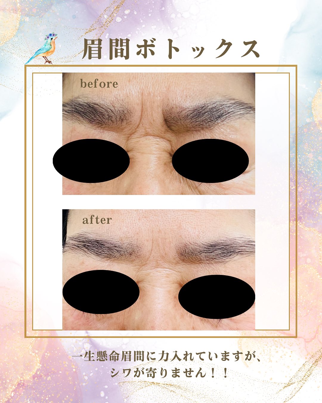 眉間ボトックスのビフォーアフターの画像。一生懸命眉間に力を入れていますが、シワが寄りません！