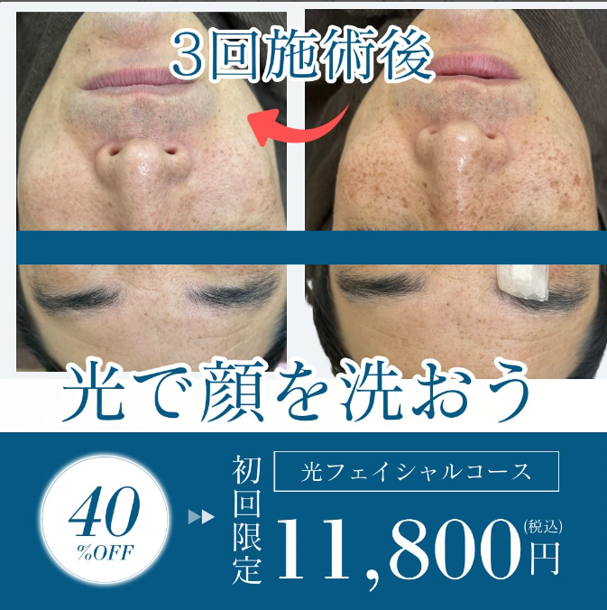 3回施術後光で顔を洗おう